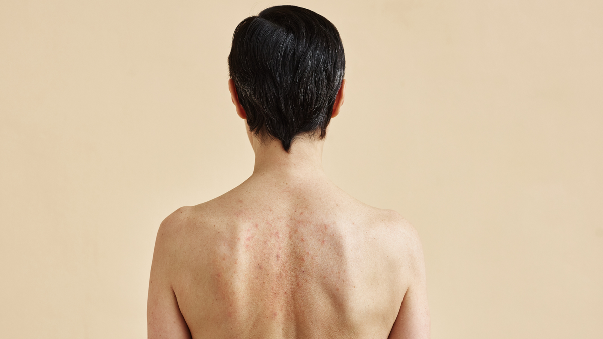 Acné corporelle : comprendre et apaiser les boutons sur le dos, la poitrine ou les épaules