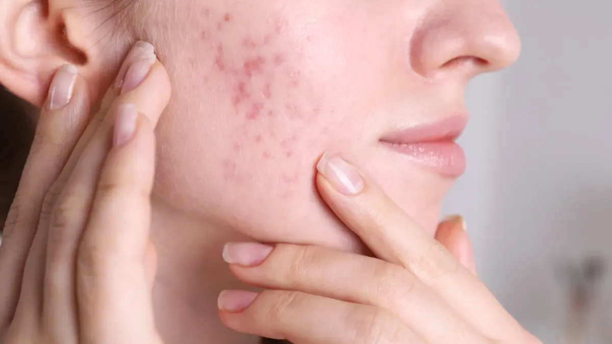 Acné hormonale : La comprendre pour la combattre