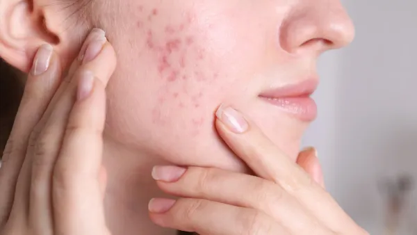 Acné hormonale : La comprendre pour la combattre